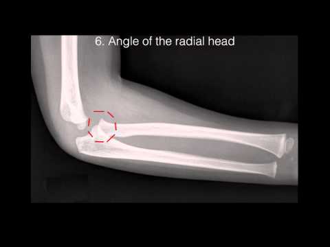 Emergency Elbow X-rays
