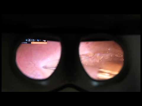 Head and Neck Cancer Robotic Surgery | Birmingham, Ala.