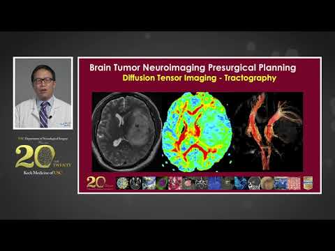 The USC Brain Tumor Center: State-of-the-Art Treatment