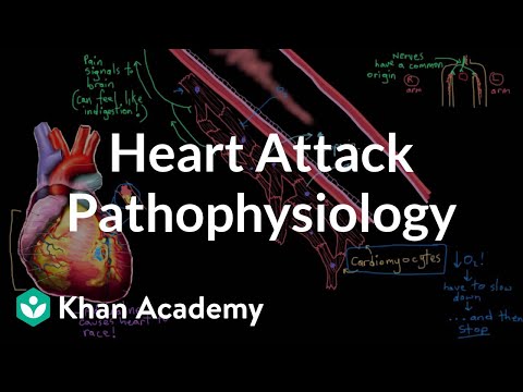 Heart attack (myocardial infarction) pathophysiology |...