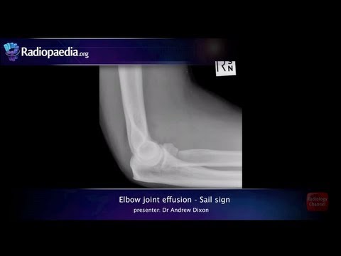 Elbow joint effusion and the sail sign - radiology...