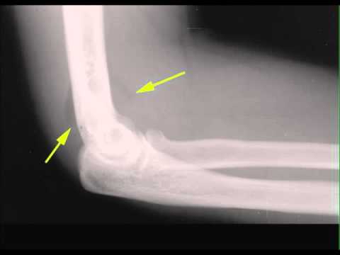 Fracture Radial Head on X ray